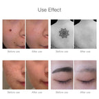 Neatcell Picosecond Laser Pen: Skin Care Beauty Device-2