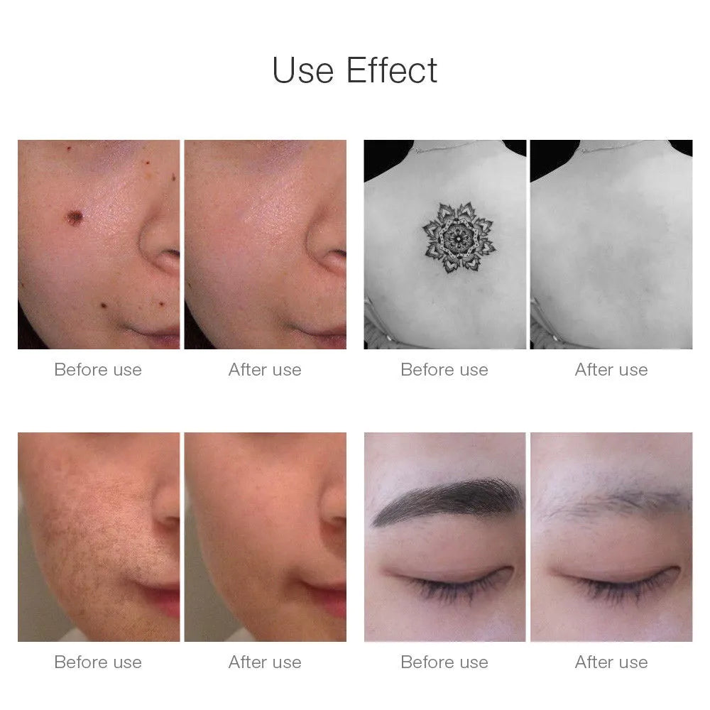 Neatcell Picosecond Laser Pen: Skin Care Beauty Device-2